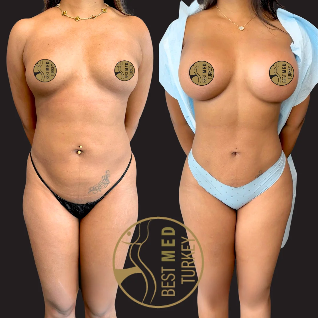 breast lift (2)