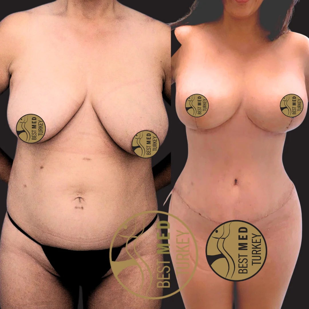 breast lift (4)