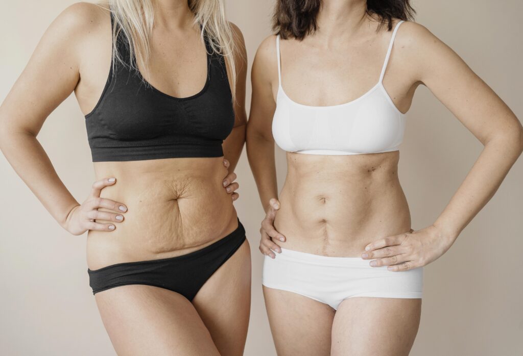 Tummy Tuck vs Liposuction: Key Differences and How to Choose the Right Procedure