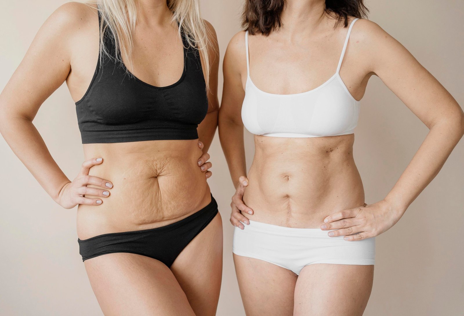 Tummy Tuck vs Liposuction