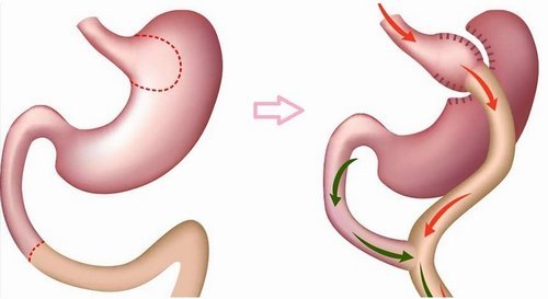 Top Benefits of Getting a Gastric Balloon Procedure in Turkey