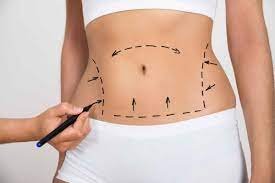 Différents types de techniques de liposuccion : laquelle est faite pour vous ?