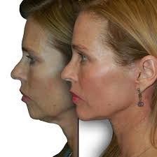 Before and After: Real Results from Facial Lipofilling at Best Med Turkey