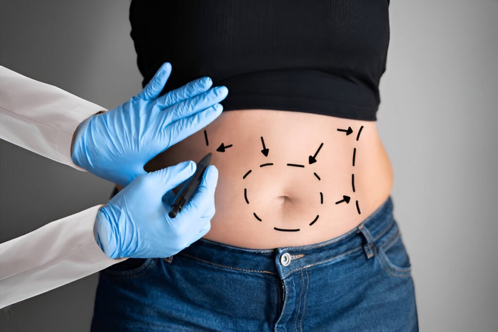 Abdominoplasty vs. Liposuction: Which Procedure Is Right for You?