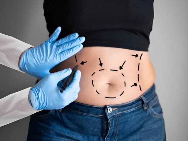 Abdominoplasty vs. Liposuction: Which Procedure Is Right for You?