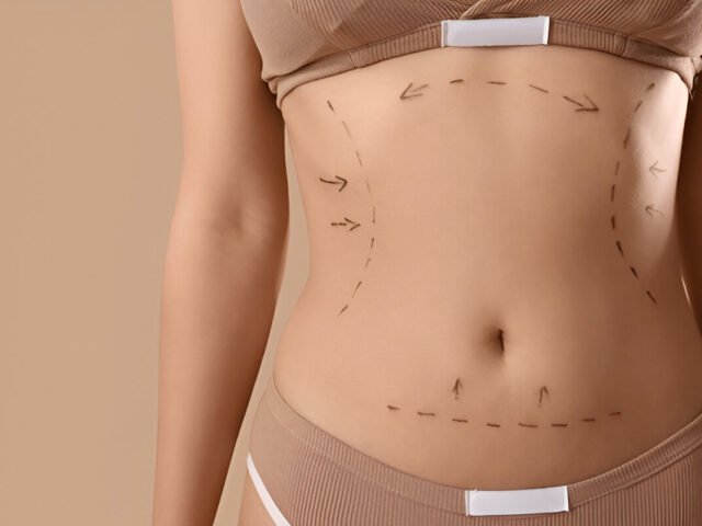 The Complete Recovery Guide After Abdominoplasty: Tips for a Smooth Healing Journey