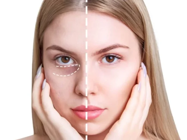 Principales Beneficios del Lightning Filler: El Secreto para una Mirada Más Brillante y Juvenil