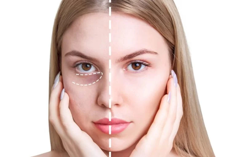 Principales Beneficios del Lightning Filler: El Secreto para una Mirada Más Brillante y Juvenil