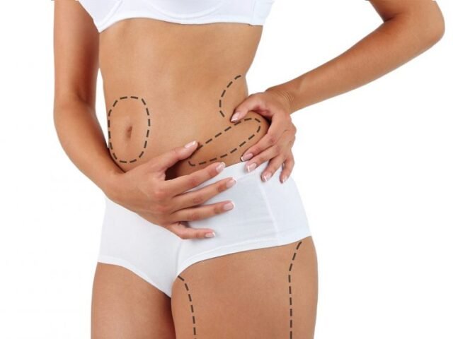 Liposucción vs. reducción de grasa no quirúrgica: diferencias clave que debes conocer