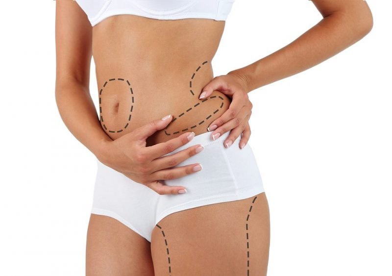 Liposucción vs. reducción de grasa no quirúrgica: diferencias clave que debes conocer