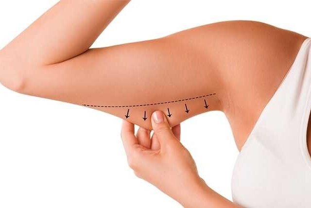 Everything You Need to Know About Arm Lift Surgery in Istanbul