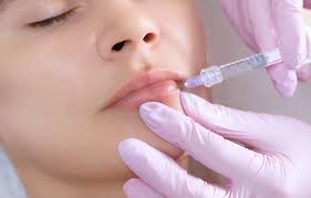 Natural vs. Voluminous: Choosing the Perfect Lip Filler Look for You